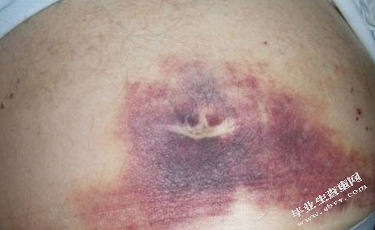一例重症急性胰腺炎患者的护理体会