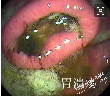 胃溃疡的中医研究进展