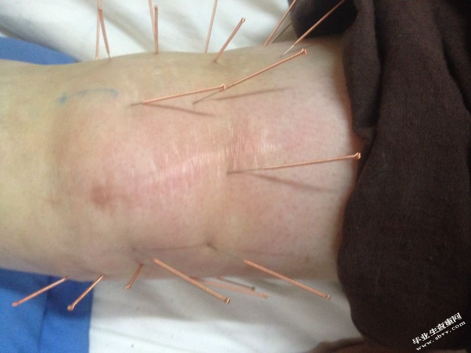 恢刺治疗膝关节骨性关节炎的临床疗效观察