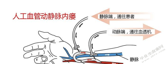 血液透析患者动静脉内瘘的护理技巧