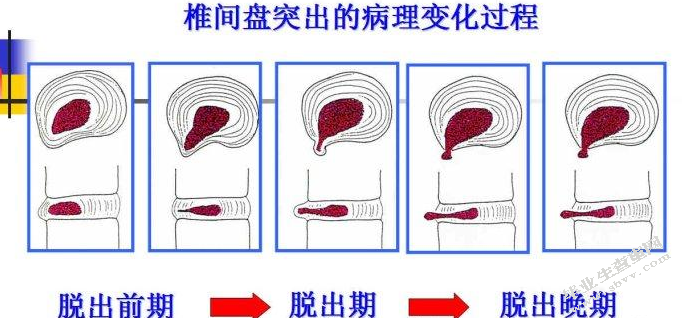 腰椎间盘突出的自我疗法