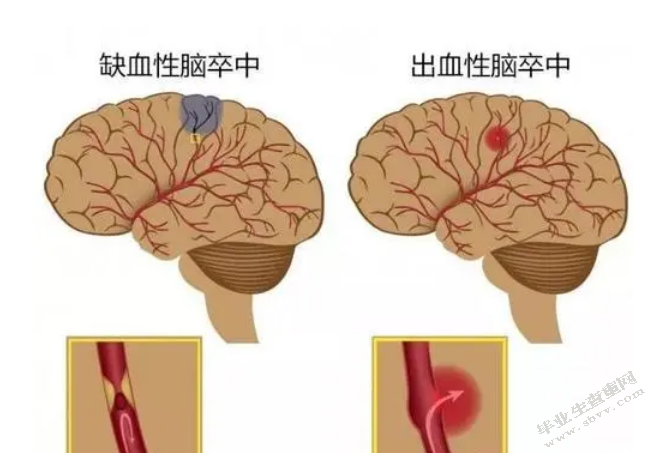脑卒中患者连续康复护理模式的构建