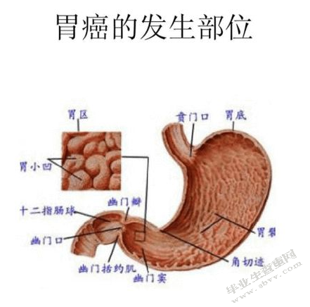 胃癌手术后化疗的护理