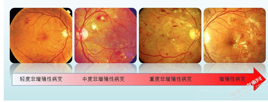 糖尿病早期视网膜神经变性