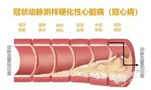 浅谈替格瑞洛对治疗ACS患者的特点及倍林达在心内科的销售策略