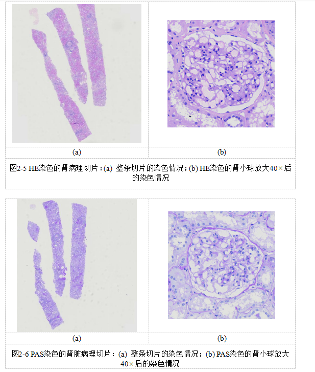 基于多示例学习的糖尿病肾病中基底膜增厚的识别