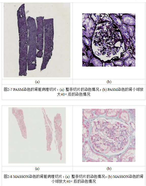 基于多示例学习的糖尿病肾病中基底膜增厚的识别