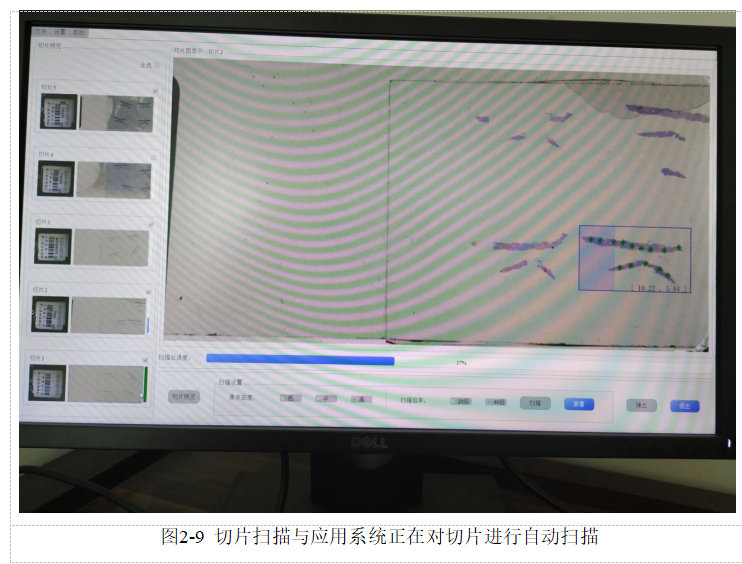 基于多示例学习的糖尿病肾病中基底膜增厚的识别