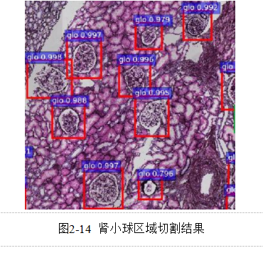 基于多示例学习的糖尿病肾病中基底膜增厚的识别